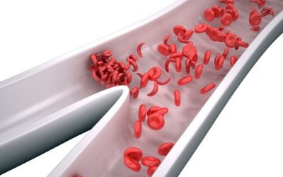 Sickle Cell Disease & Medical Marijuana in Ohio