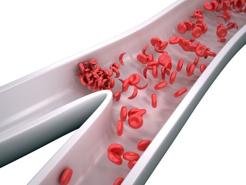 Sickle Cell Disease & Medical Marijuana in Ohio