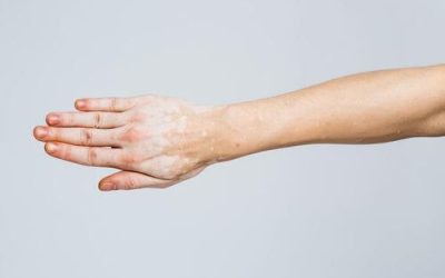 Is Cannabis Effective in Treating Autoimmune Diseases in Ohio?