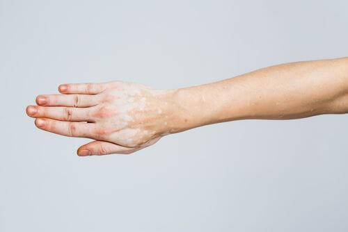 Is Cannabis Effective in Treating Autoimmune Diseases in Ohio?