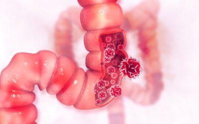 Can Medical Marijuana Help Treat Colorectal Cancer?