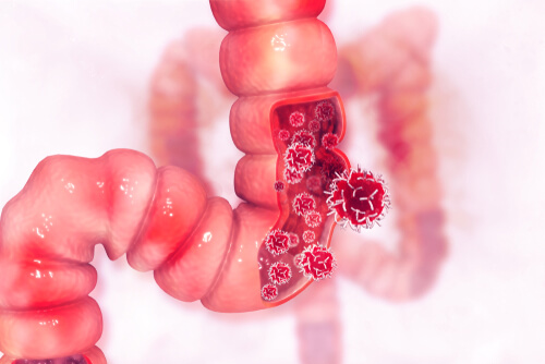 Can Medical Marijuana Help Treat Colorectal Cancer?