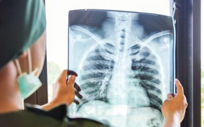 Can Medical Cannabis Treat Tuberculosis?