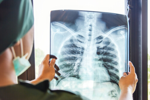 Can Medical Cannabis Treat Tuberculosis?