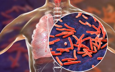 Can Cannabis Treat TB?