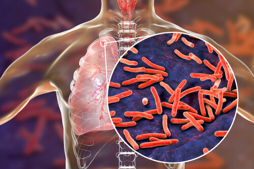 Can Cannabis Treat TB?