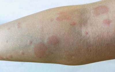 Medical Cannabis For Lupus: Can It Help Manage Symptoms and Summer Flare-Ups?