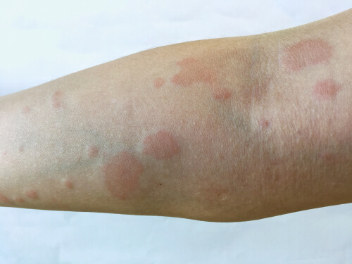 Medical Cannabis For Lupus: Can It Help Manage Symptoms and Summer Flare-Ups?