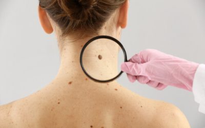 Is Cannabis an Effective Treatment Option for Skin Cancer?