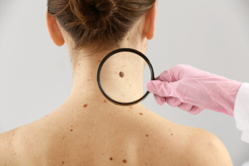 Is Cannabis an Effective Treatment Option for Skin Cancer?