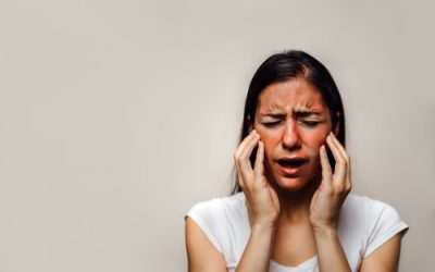 Is Lupus a Qualifying Condition for an Ohio Medical Marijuana Card?