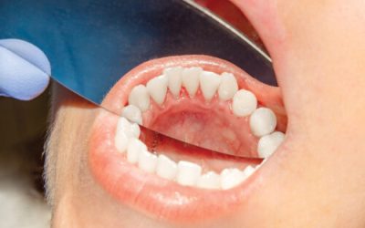Long-Term Cannabis Use & Risk of Oral Cancer: What Ohio MMJ Patients Should Know