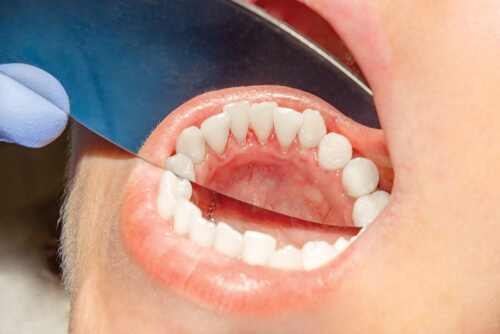 Long-Term Cannabis Use & Risk of Oral Cancer: What Ohio MMJ Patients Should Know
