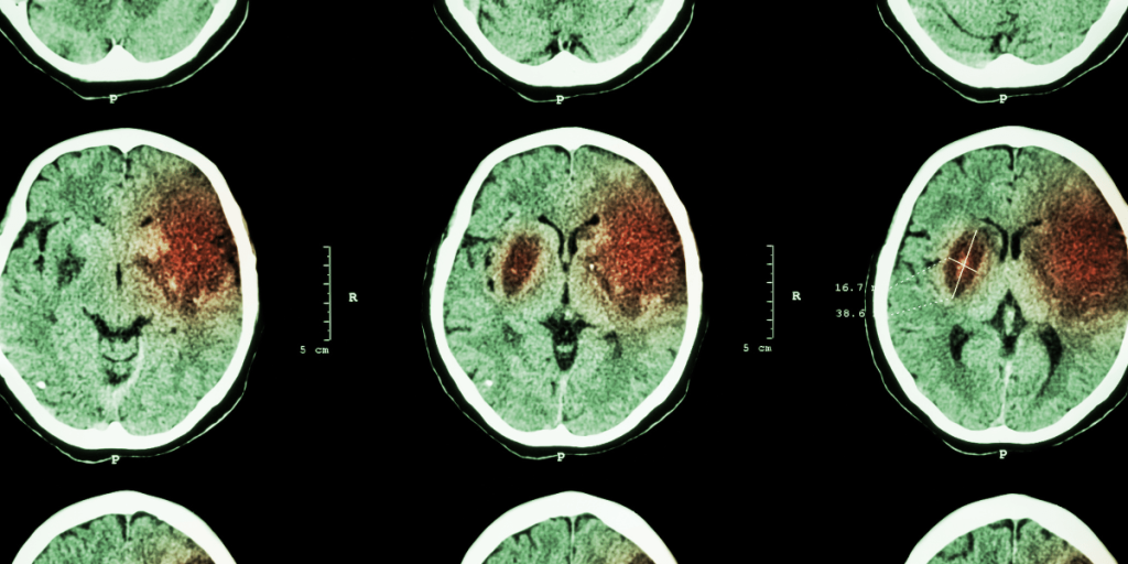 brain scan
