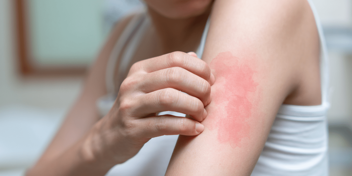 skin rash after cannabis topicals